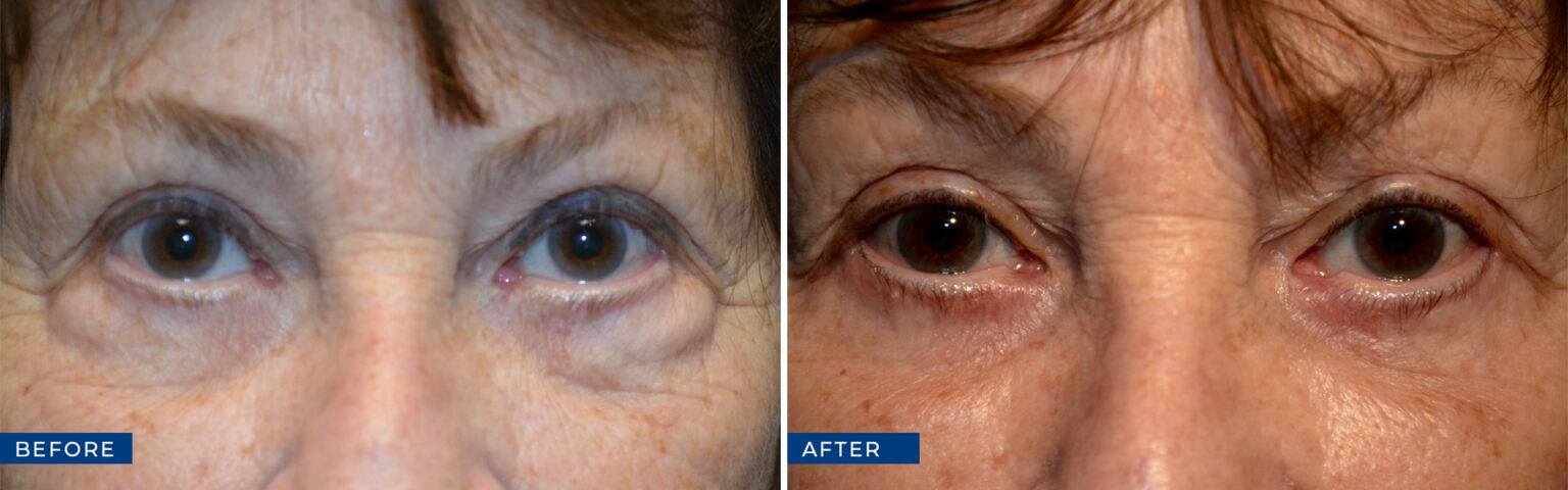 Oculoplastic Surgery Before And After Gallery Eye Care Associates Of