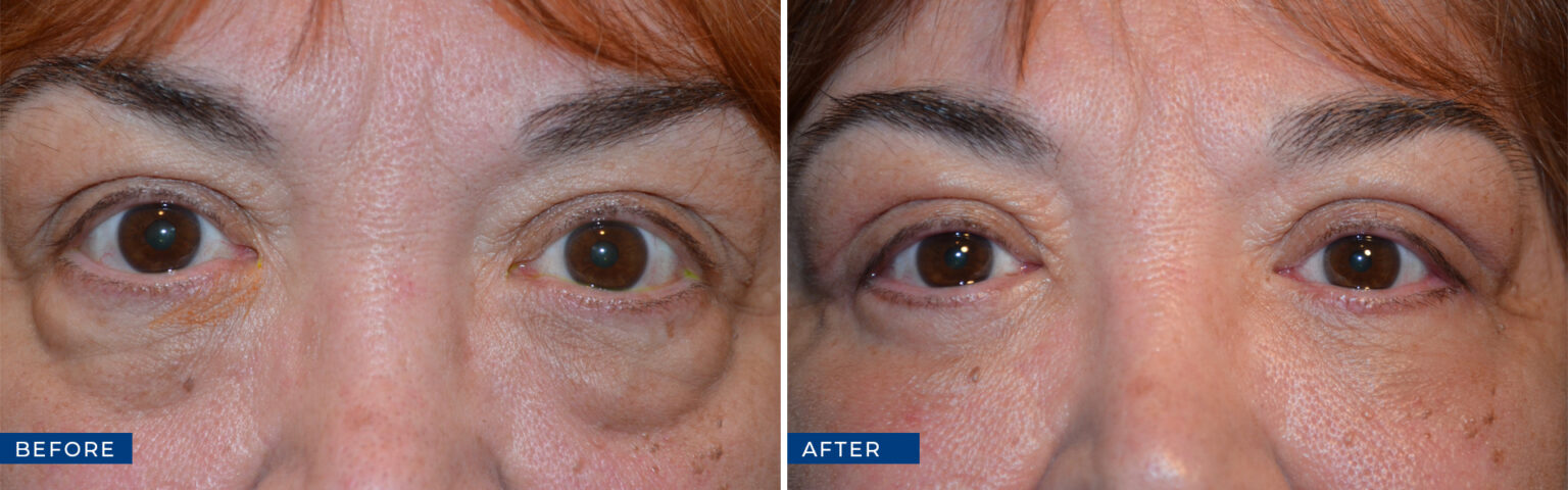 Oculoplastic Surgery Before And After Gallery - Eye Care Associates Of ...