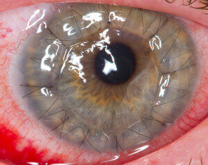 Eye one day after cornea transplant