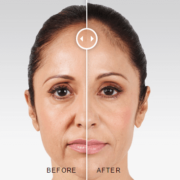 Juvederm before and after