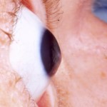 Keratoconus