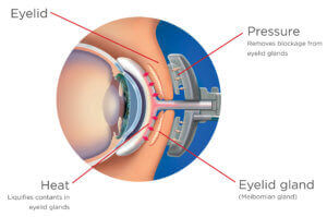 LipiFlow treatment diagram