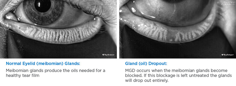 LipiView Gland Comparison