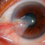 Pterygium