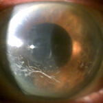 Cornea Dystrophy