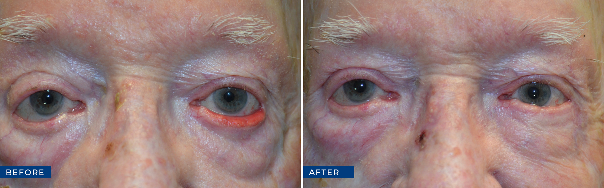 Repaired Ectropion before and after photo