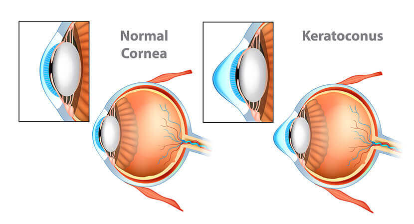 Keratoconus Diagram