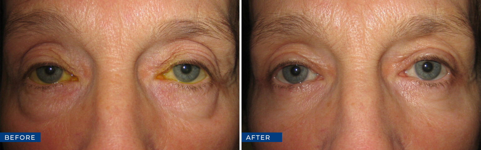 Oculoplastic Surgery Before And After Gallery - Eye Care Associates Of ...