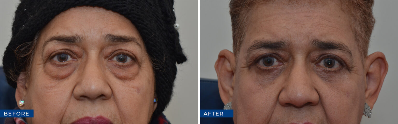 Oculoplastic Surgery Before And After Gallery - Eye Care Associates Of ...