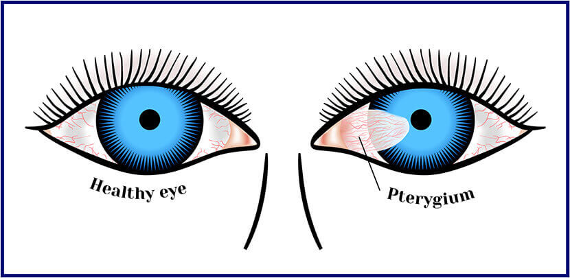 Illustration of normal eye vs pterygium